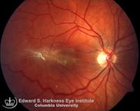 Opaque membrane obscures the visibility of the macula and drags the paramacular vessels.